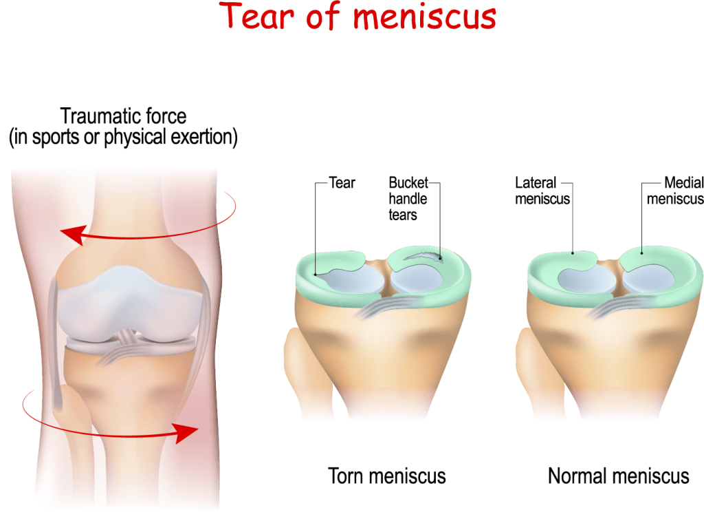 meniscus tear