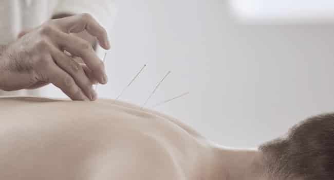 acupuncture needling therapy oakville on