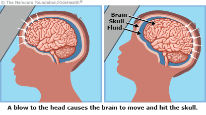 Understanding Concussions: The Hidden Impact on Brain Health - Physio Pros