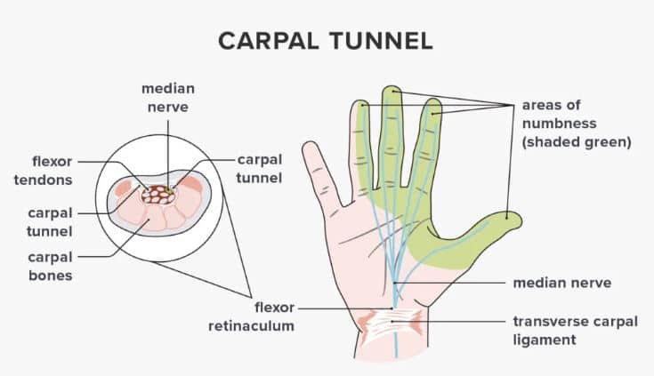 carpel-tunnel-syndrome